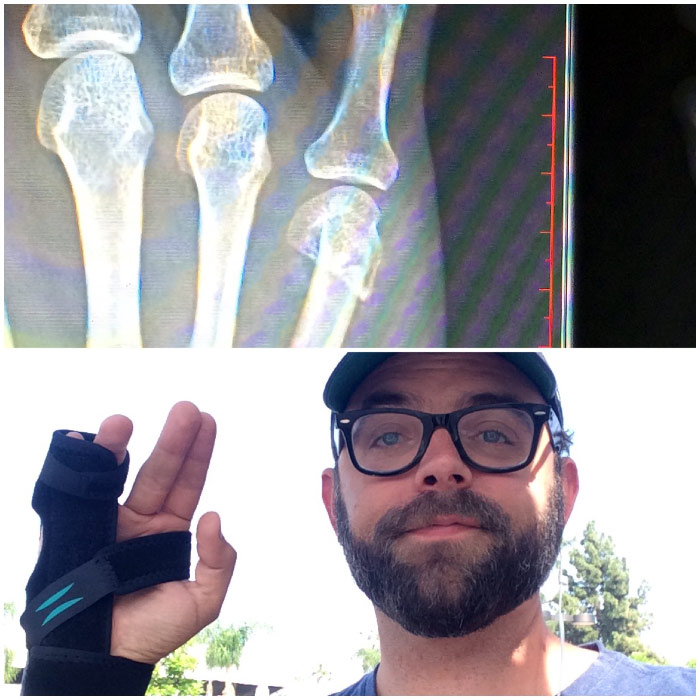 Andy's broken hand